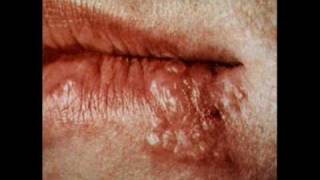 Cold Sore Information and Treatment [upl. by Hanikas]