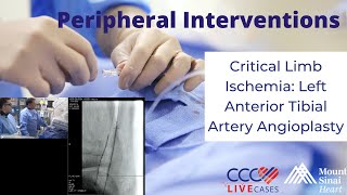 Critical Limb Ischemia Left Anterior Tibial Artery Angioplasty  March 28 2018 [upl. by Attolrahc]