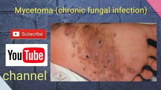 Mycetoma chronic fungal infection [upl. by Hodge]