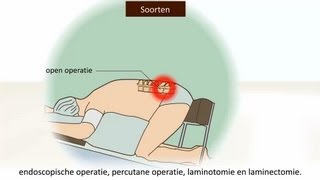 Herniaoperatie  Welke soort is het meest effectief [upl. by Lleksah]