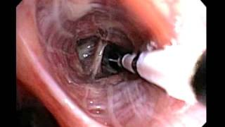 Bronchial Thermoplasty Improved Asthma Control for your Patients [upl. by Thielen]