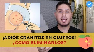 Te explico como deshacerte de los GRANITOS en los glúteos Foliculitis  DOCTOR LEMUS [upl. by Aserehs]