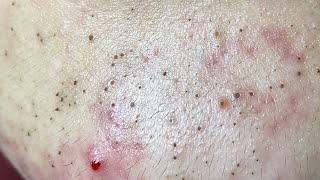 Acne Treatment Huong Da Nang The video has been lost for a long time Remove Blackheads [upl. by Yeltnarb]