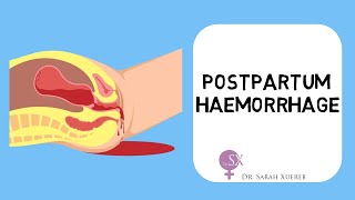 Postpartum Haemorrhage [upl. by Hidie]