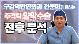 구강악안면외과 전문의s 주걱턱 양악수술 전후로 분석하기 ㅣ 줌구강악안면외과 [upl. by Poyssick]