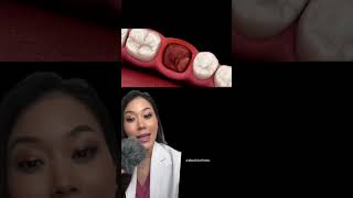 How to avoid dry socket after wisdom tooth extraction wisdomtooth wisdomteeth drysocket tooth [upl. by Eiclek]