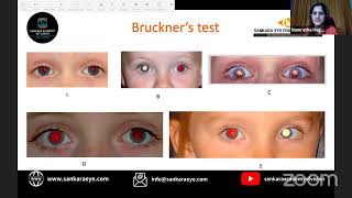 what test which age  pediatric optometric exam Learn from the Masters  Sankara Academy of Vision [upl. by Lahsram]