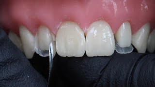 Peg Laterals Restorations with Rhodri Thomas BDS [upl. by Anwahs]