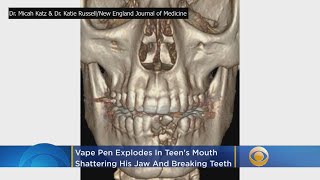 Vape Pen Explodes In Teens Mouth Shattering His Jaw [upl. by Akitan]