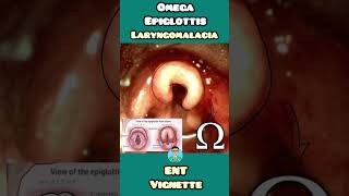 Omega Epiglottis in Laryngomalacia made easy for USMLE NEET PG INCET NCLEX [upl. by Carline904]