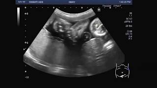 Ultrasound Video showing a rare case of fetal anomaly called Gastroschisis [upl. by Leiand]