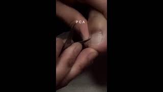 Removing Dry Skin of TOEnaiLs [upl. by Anidem]