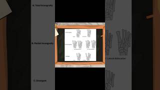 Classification of Lisfranc Injuries lisfranc ortholectures orthopaedics orthodoc ortho [upl. by Levitus]