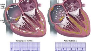 Atrial Fibrillation [upl. by Nanor71]