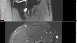 Elbow MRI Approach to MSK MRI Series [upl. by Enelram]