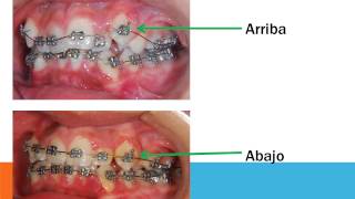Como Funciona la Ortodoncia VIDEO DIDÁCTICO [upl. by Luar]