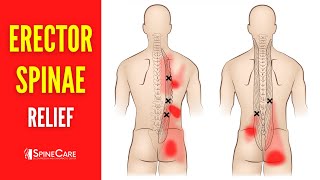 How to Fix Erector Spinae Pain FOR GOOD [upl. by Fauver]