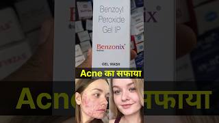 acne killer ।। benzonix gel wash ।। benzoyl peroxide for acne [upl. by Hoopen]