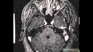 Mastoiditis Brain Abscess DISCUSSION [upl. by Brear]