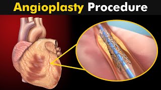 How Angioplasty Procedure is performed [upl. by Uah847]