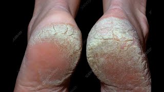 Palmoplantar Psoriasis Dos amp Donts  உள்ளங்கால் சொரியாசிஸ் சவால்  Dr Selvin [upl. by Loriner]