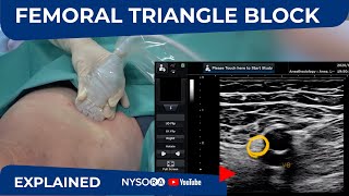 UltrasoundGuided Femoral Triangle Nerve Block  NYSORAs Regional Anesthesia Clinical cases [upl. by Githens176]