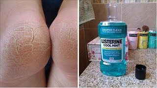 10 Amazing Uses For Listerine That Every Woman Should Know [upl. by Hurwit]