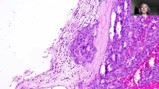 Tip86Atypical Meningioma CNS WHO grade2 [upl. by Peedus]