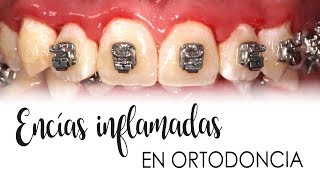 ENCÍAS INFLAMADAS CON ORTODONCIA  CAUSAS Y TRATAMIENTO [upl. by Feola]