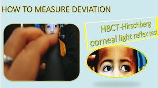 Hirschberg Test Hirschberg Corneal Reflex Test Hirschberg Test Interpretation HBCT Test HBRTCLR [upl. by Spooner228]