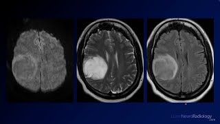 Neuroradiology Board Review  Brain Tumors  Case 2 [upl. by Jacintha428]