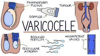 Varicoceles [upl. by Atwekk]