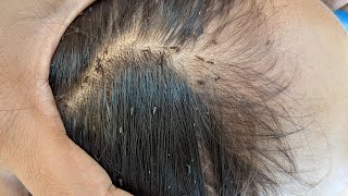 Lice Picking liceremoval lice satisfying fyp omg [upl. by Stafani]