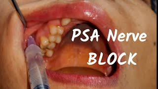 Posterior Superior nerve Block PSA Inj in dentistry Landmark amp Technique in Dental Teeth Surgery [upl. by Assyl146]