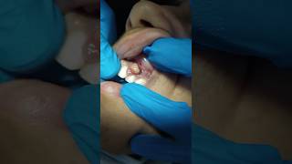 Periapical Abcess Fistula drainage dentist tooth shortsfeed shortviral shorttrending [upl. by Coppinger572]