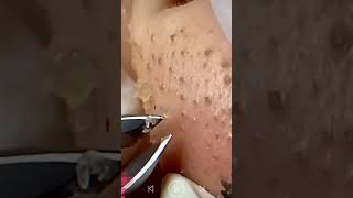 Skincare  Blackheads Removal 239 tweezers skincare blackheads blackheads [upl. by Kire862]