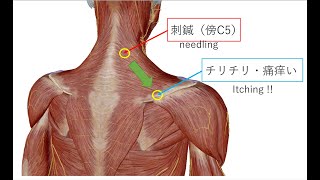 Notalgia paresthetica（錯感覚性背痛）らしき現象 [upl. by Ettenrahs]