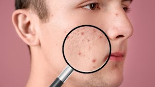 WHAT PERCENTAGE OF BENZOYL PEROXIDE SHOULD YOU USE TO HELP REDUCE ACNE AND PIMPLES [upl. by Eidua]