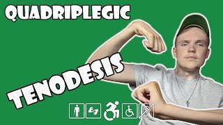 Tenodesis Grasp and Release Explained  Quadriplegic C5C6C7 [upl. by Tedd]