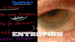 What is Entropion  And it’s types  signs and symptoms  and treatment explained in very easy words [upl. by Nwahsor]