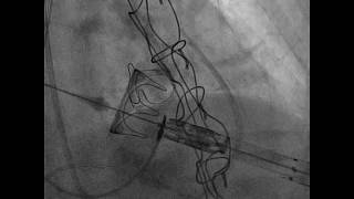 Mitral ValveInValve Procedure with Transcatheter Device [upl. by Helsie]