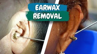 MORE earwax removal from clinic in rural Mexico COMPILATION [upl. by Ajna688]