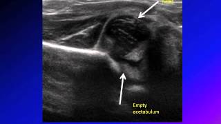 DDH developmental dysplasia of hip congenital hip dislocation CHD [upl. by Benildis208]