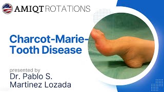 POLYNEUROPATHYCHARCOT MARIE TOOTH DISEASE Pablo Martinez Lozado [upl. by Llebyram419]