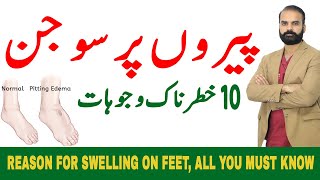 10 Dangerous Reasons for Swelling on Feet  What causes swollen legs and feet【Edema in HindiUrdu】 [upl. by Odnomor]