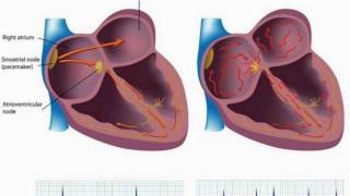 Difference Between Atrial Fibrillation and Atrial Flutter [upl. by Chappelka642]