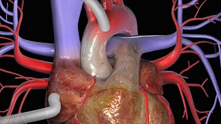 Graft di Bypass Aortocoronarico CABG [upl. by Imefulo341]