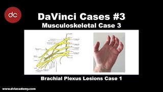 Brachial Plexus Case 1 DaVinciCases Musculoskeletal 3 [upl. by Enneite]