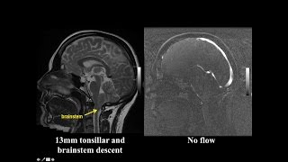 Cine MRI for Chiari I Malformation [upl. by Iznyl713]