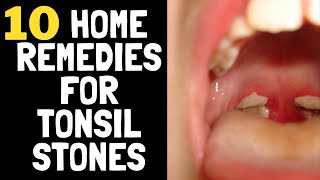 10 Home Remedies For Tonsil Stones That Work Fast  How To Get Rid of Tonsil Stones at Home [upl. by Gamal660]